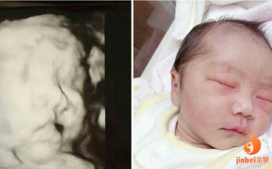 杭州代生女孩,【上海正规供卵医院地址】超大龄多囊卵巢北医三院人工授精经